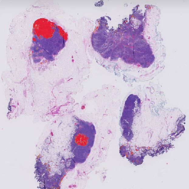 AI application (Hooknet algorithm) to detect tumor in lymph nodes. Source: https://grand-challenge.org/algorithms/