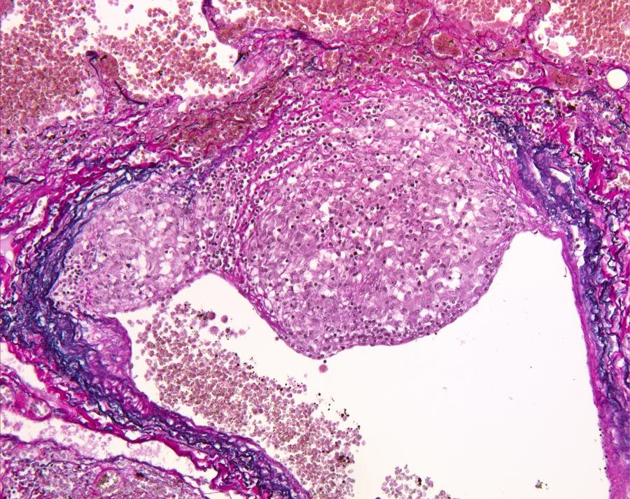 Digital slide sarcoid